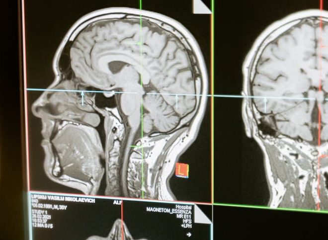 Ученые выявили у умерших от COVID-19 изменения в мозге как при болезни Альцгеймера