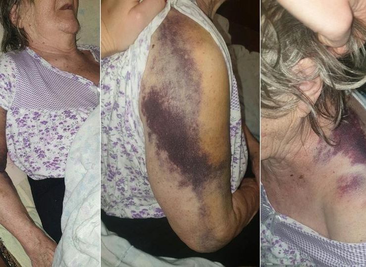 В Нижнем Тагиле пенсионерку выписали из «ковидной» больницы с синяками и переломом