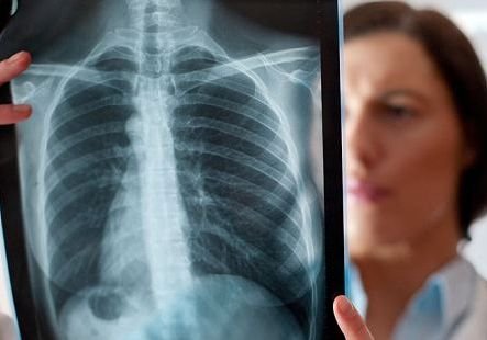 Смертность от туберкулеза в Рязани сократилась вдвое