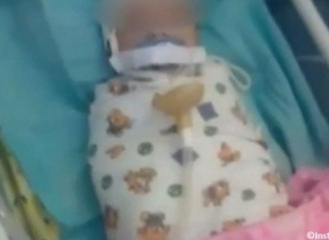 В Ингушетии в перинатальном центре младенцу заклеили рот пластырем