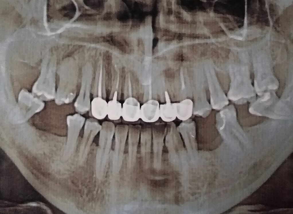 В рязанской стоматологии пациенту поставили некачественный протез и пять лет отказывались исправлять