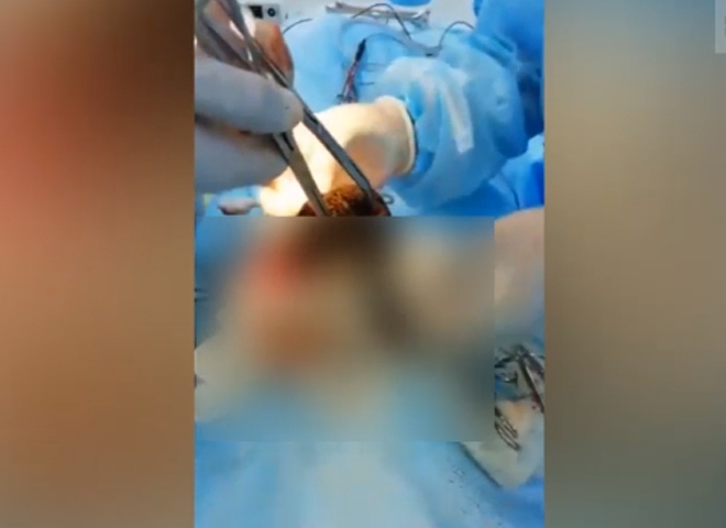 В Казахстане из желудка девочки удалили 3,5 кг волос (видео)