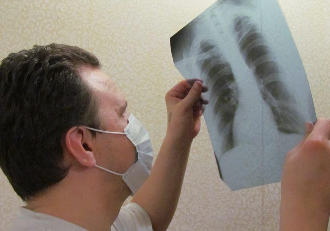 В Рязани смертность от туберкулеза снизилась на 31,7%