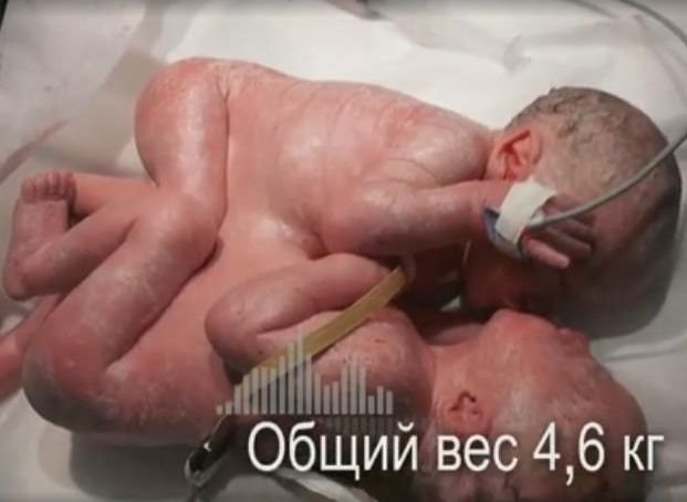 Московские врачи успешно разделили рязанских сиамских близнецов