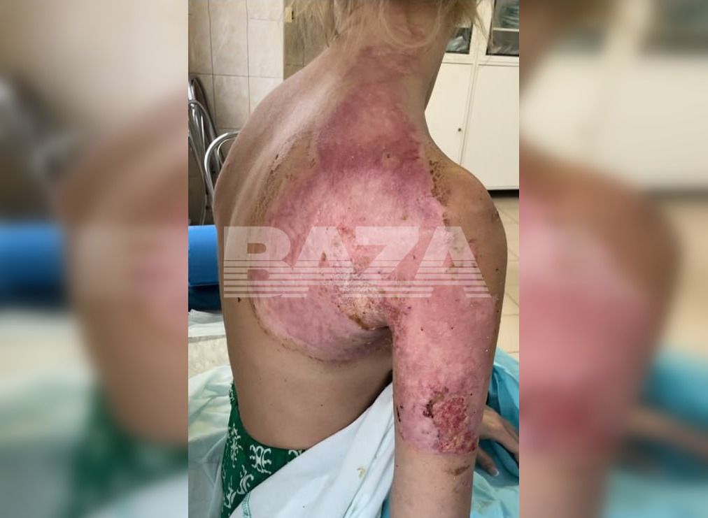 Пациентка загорелась во время операции в НИИ Склифосовского