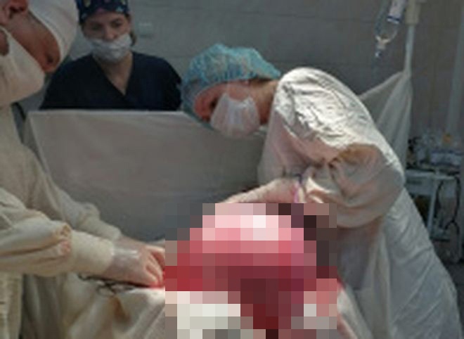 В Рязани 38-летней женщине удалили 20-килограммовую опухоль