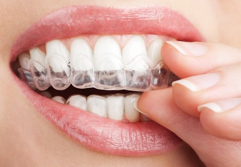 Рязанские стоматологи начали применять невидимые брекеты