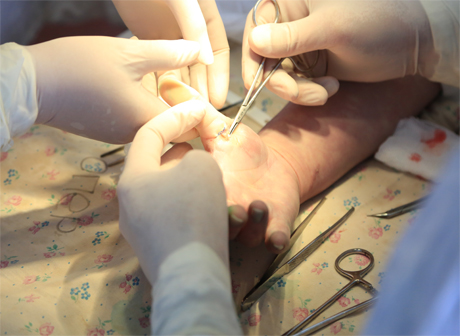 Хирурги в Томске пересадили пациенту палец со стопы на кисть