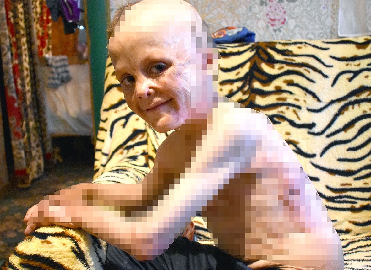 Шестилетнему рязанскому мальчику, получившему ожоги 80% тела, нужна помощь