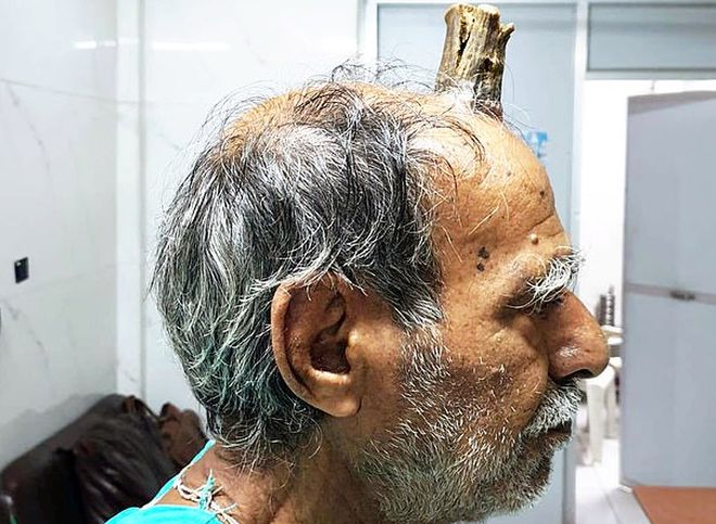 В Индии у мужчины вырос 10-сантиметровый «дьявольский» рог