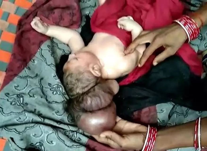 В Индии родился трехголовый младенец