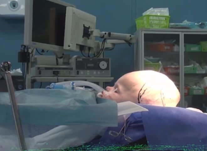 Рязанскому малышу провели уникальную операцию по уменьшению головы