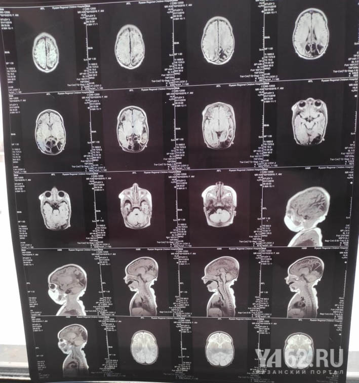 Фото 3 МРТ ребенка после рождения в Перинатальном центре — копия-2.JPG